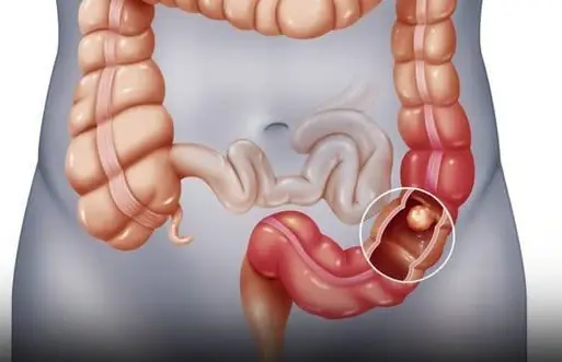 Paralytic ileus: Causes, symptoms, treatment and prevention