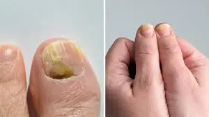 Nail Changes Like Ridges or Discoloration Shouldn’t Always Be Ignored