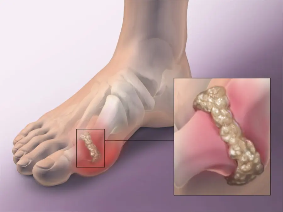 Doctors Reveal the Worst Foods for People Living With Gout
