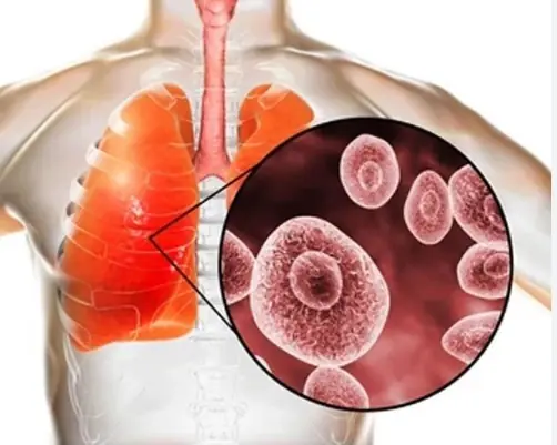 5 warning signs your respiratory system could be affected by mold