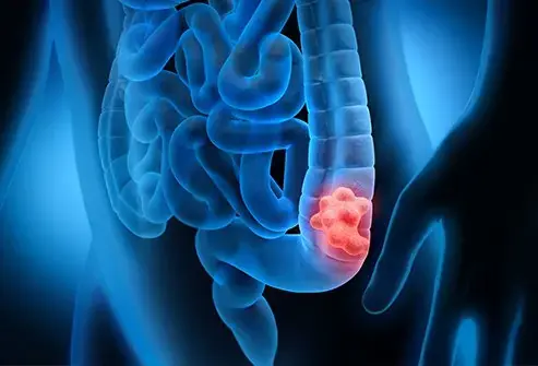 Col.on Can.cer Stage 1: 6 Silent Symptoms You Must Not Overlook