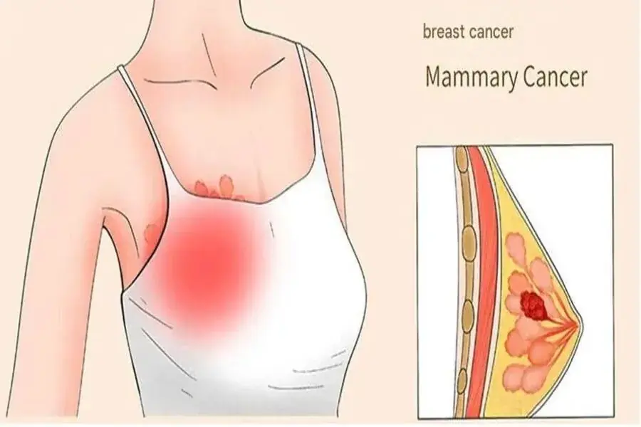 Your Body May Be Sending Early Breast Cancer Signals — Here’s What to Look For