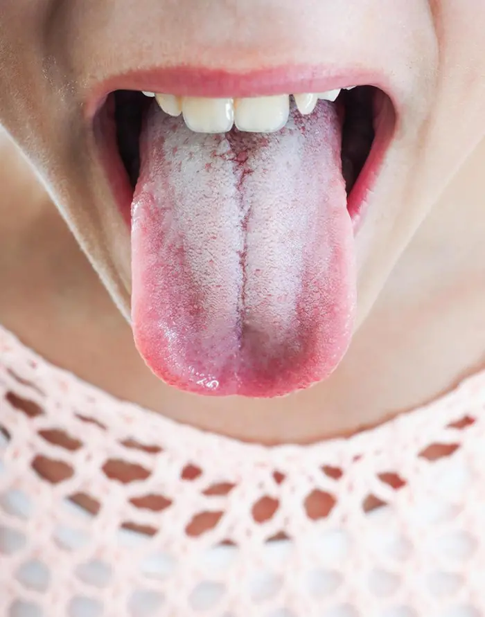 A White Tongue Could Be a Sign of an Underlying Health Issue — Here’s What Doctors Say