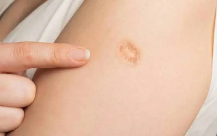 Why So Many People Have This Small Scar on Their Left Arm?