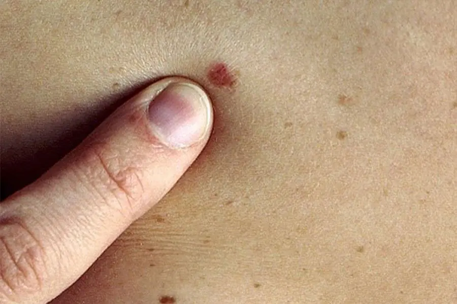 Tiny Red Dots on the Skin: Reasons They Appear and When to Pay Attention