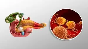 Pancreatic Cancer Can Be Hard to Detect — These Early Signs May Help