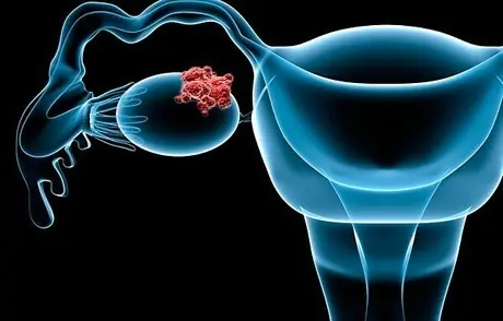8 Possible Early Symptoms of Ovarian Can.cer You Should Never Ignore
