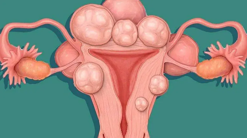 How Uterine Fibroids May Affect the Body: Common Symptoms to Watch For