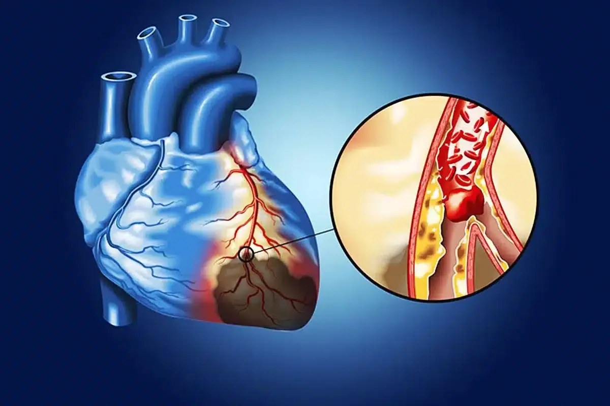Many Young People Ignore These 6 Symptoms — But They Could Be Linked to Heart Damage