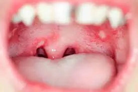 These small white bumps in the mouth might mean more than you think
