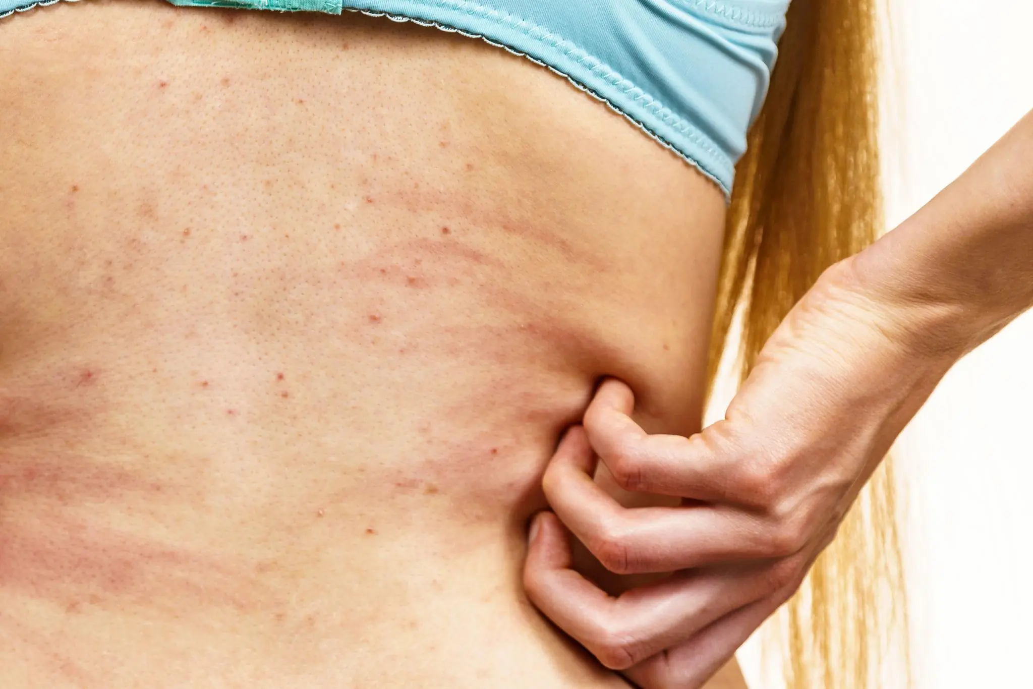 8 Surprising Hives Triggers You Might Be Overlooking, According to Experts