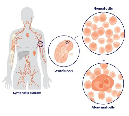 What Role Does the Lymphatic System Play in Can.cer Progression? Experts Explain