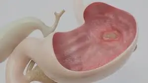 Many People Ignore These 5 Early Ulcer Symptoms Until It Gets Worse