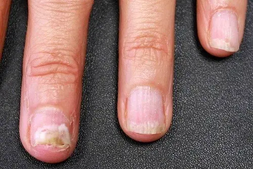 Your Nails May Be Showing Important Clues About Your Health
