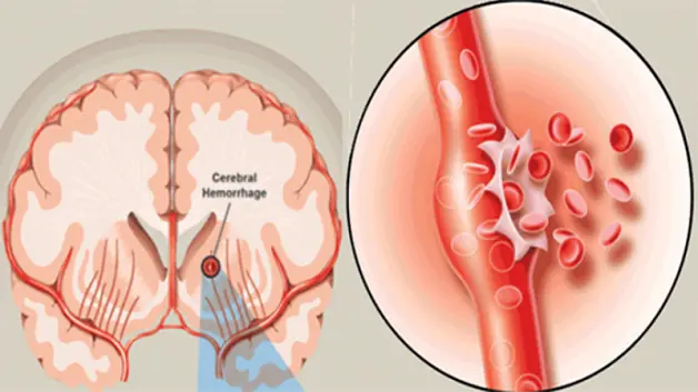 Aneurysm Warning Signs and Symptoms That Deserve Immediate Attention