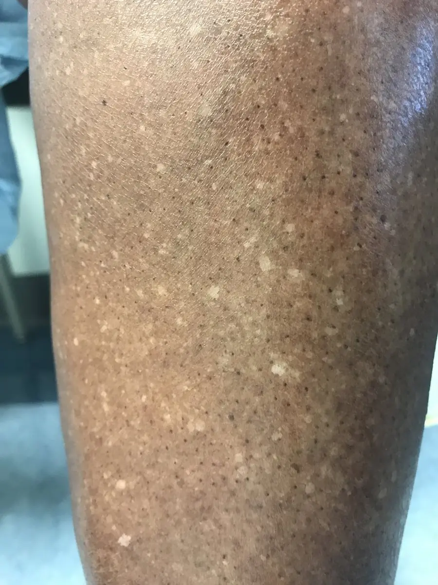 Doctors Explain Why White Spots Sometimes Appear on the Arms and Legs