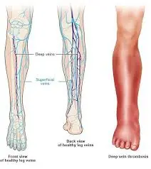 Doctors Warn Poor Circulation Can Worsen Over Time — Here’s a Simple Drink People Use for Support