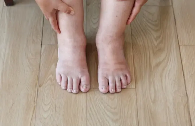 Everyday Habits That May Help Relieve Fluid Retention and Puffiness