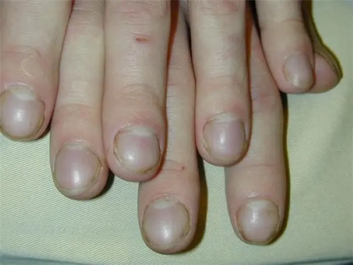 7 Finger and Nail Changes That Could Be Important Warning Signs of Lung Problems