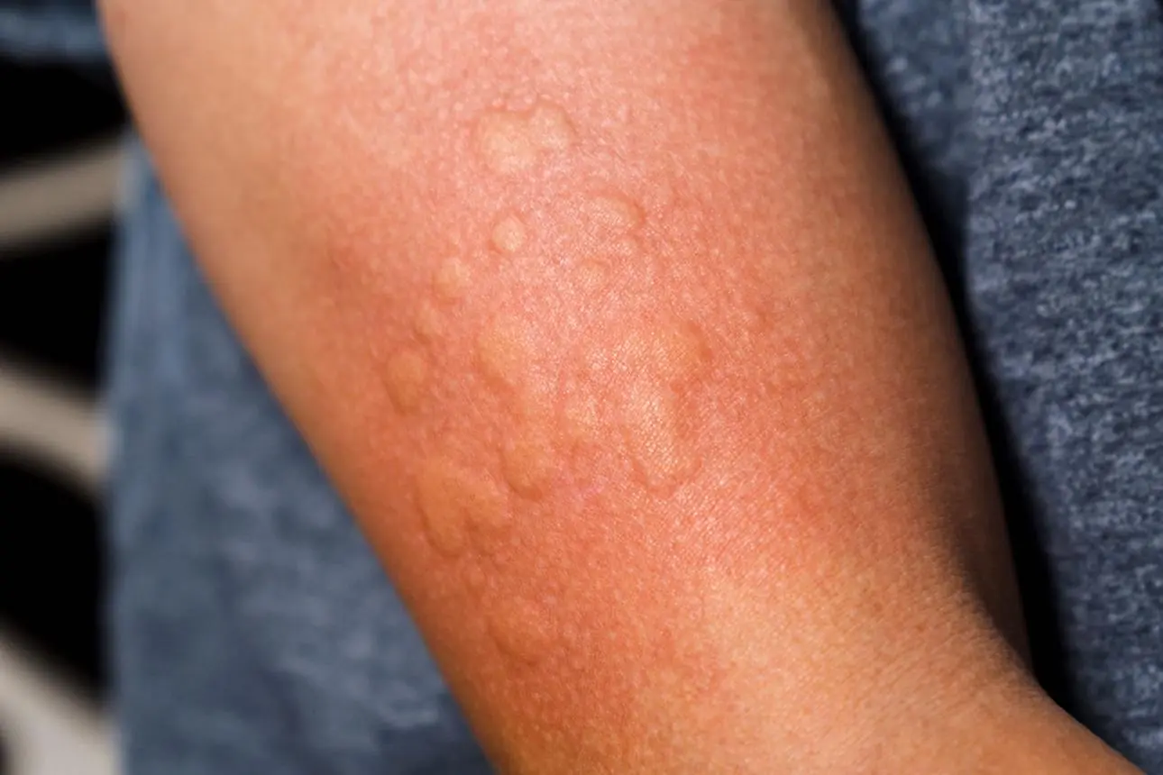 Doctors Explain the Possible Causes of Skin Irritation During Sleep