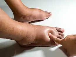 Your Swollen Hands and Feet Might Be Warning Signs of These Conditions