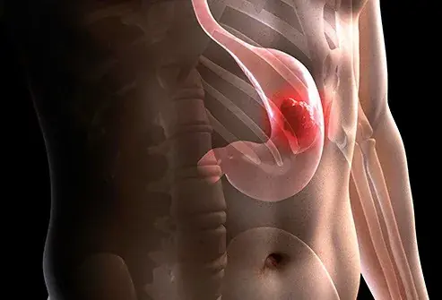 10 Early Signals of Sto.mach Cancer Many People Overlook
