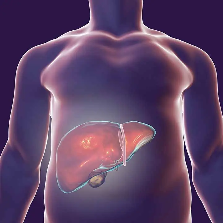 Liver Disease Can Sometimes Cause Abdominal Swelling That Looks Like Fat
