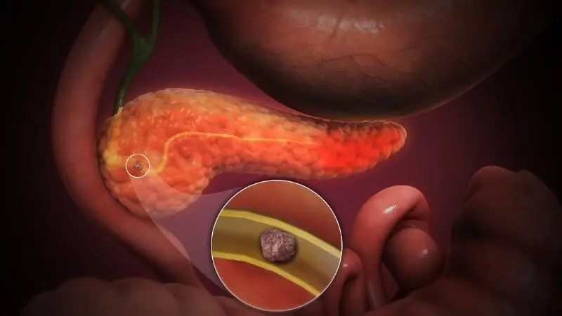 Early detection matters: signs of pancreatic cancer to look out for