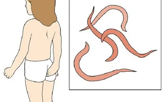 Pinworms: the night-active parasite that bothers children