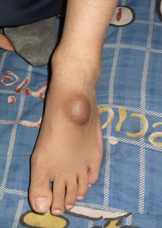 Swollen Feet? Your Body May Be Sending an Important Warning