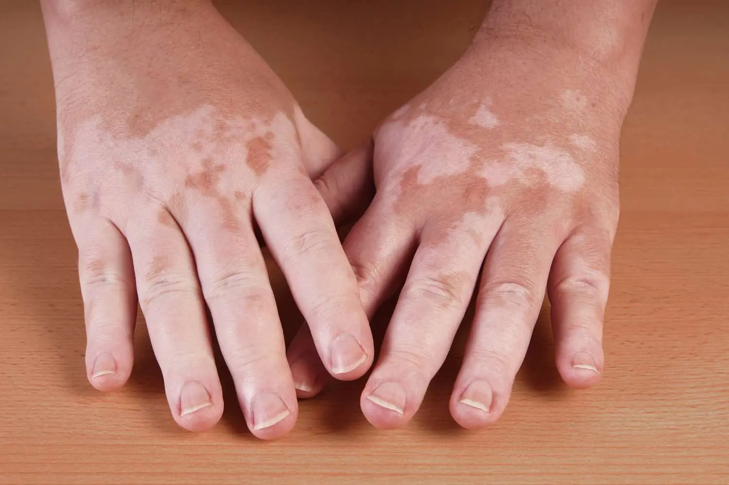 White Patches on the Skin Are Not Always Vitiligo — Here’s Why