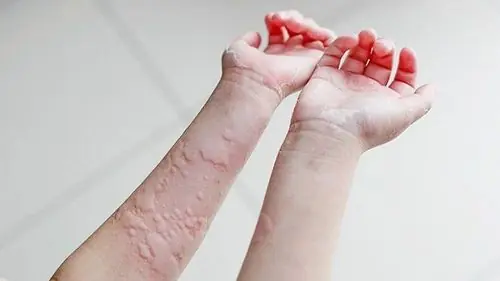 Itchy Skin and Small Bumps? Here’s What Your Body May Be Trying to Tell You