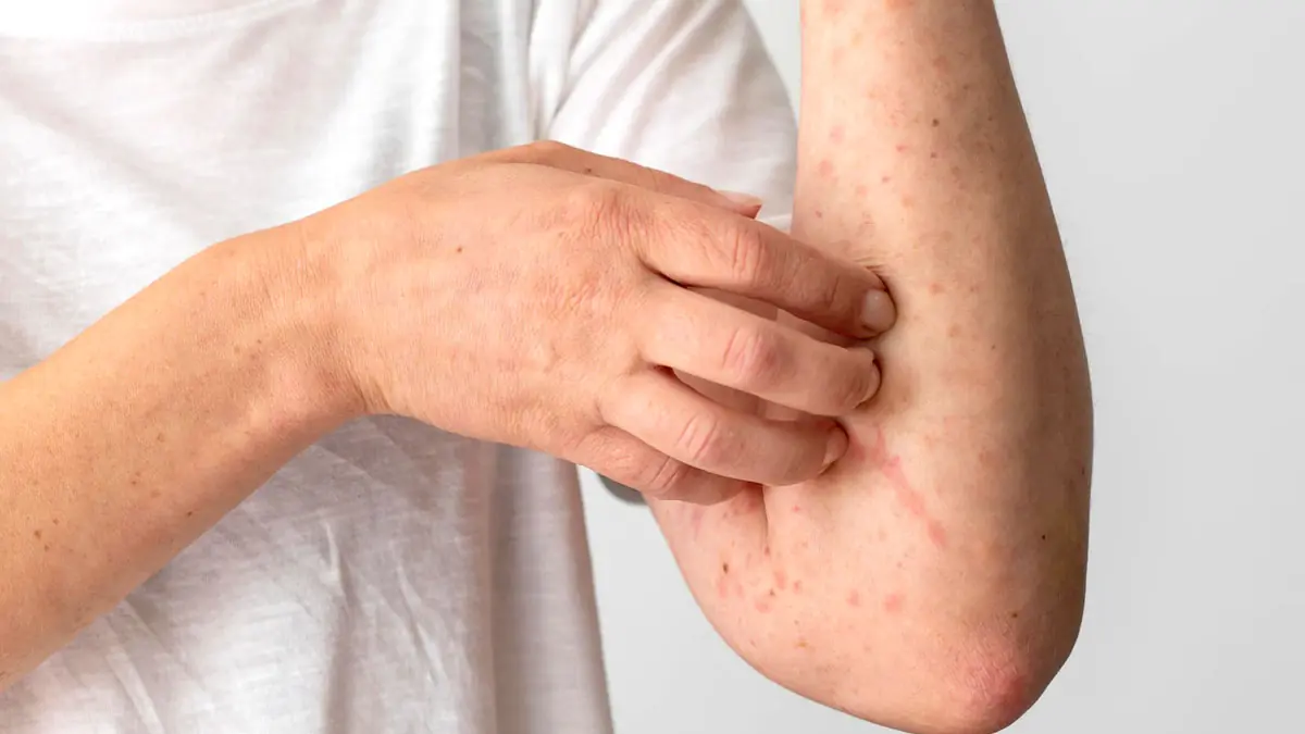 7 Skin Changes That May Sometimes Be Linked to Liver Disease