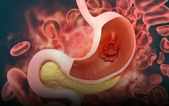 More People Are Developing Stomach Can.cer: Doctors Warn About 2 Common “Culprits” Hiding in Your Fridge