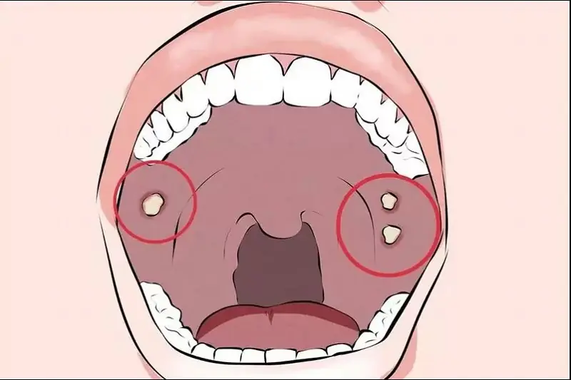 What Are Tonsil Stones? Symptoms, Causes and Helpful Care Tips?