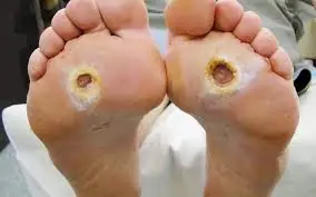 “Fish Eyes” Are NOT Calluses — Here’s the Difference