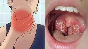 After Sneezing a Few Times, This Weird Lump Came Out of My Throat