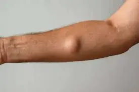 Doctors Say This Small Lump Could Be Linked to a Common Daily Habit