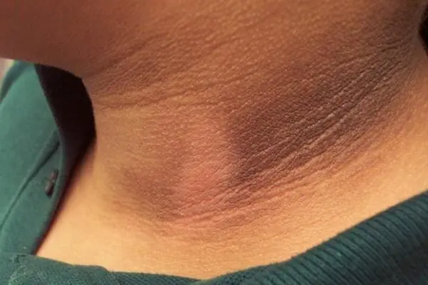 Many People Think It’s Dirt, but a Dark Neck Can Be a Serious Warning Sign