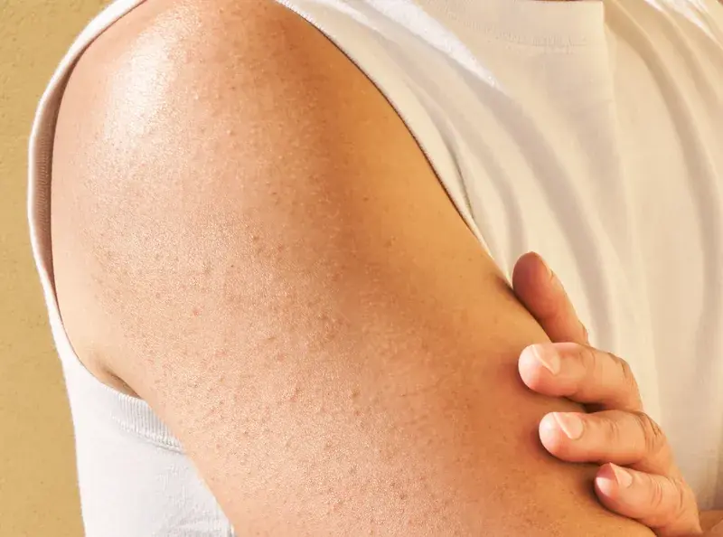 If You Have Tiny Bumps on Your Arms, Here’s What Your Skin May Be Telling You