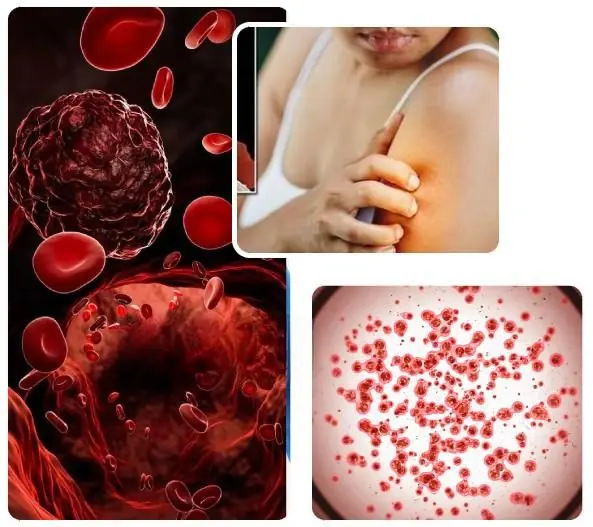 10 Early Clues Your Body May Give Before a Blood Cancer Diagnosis