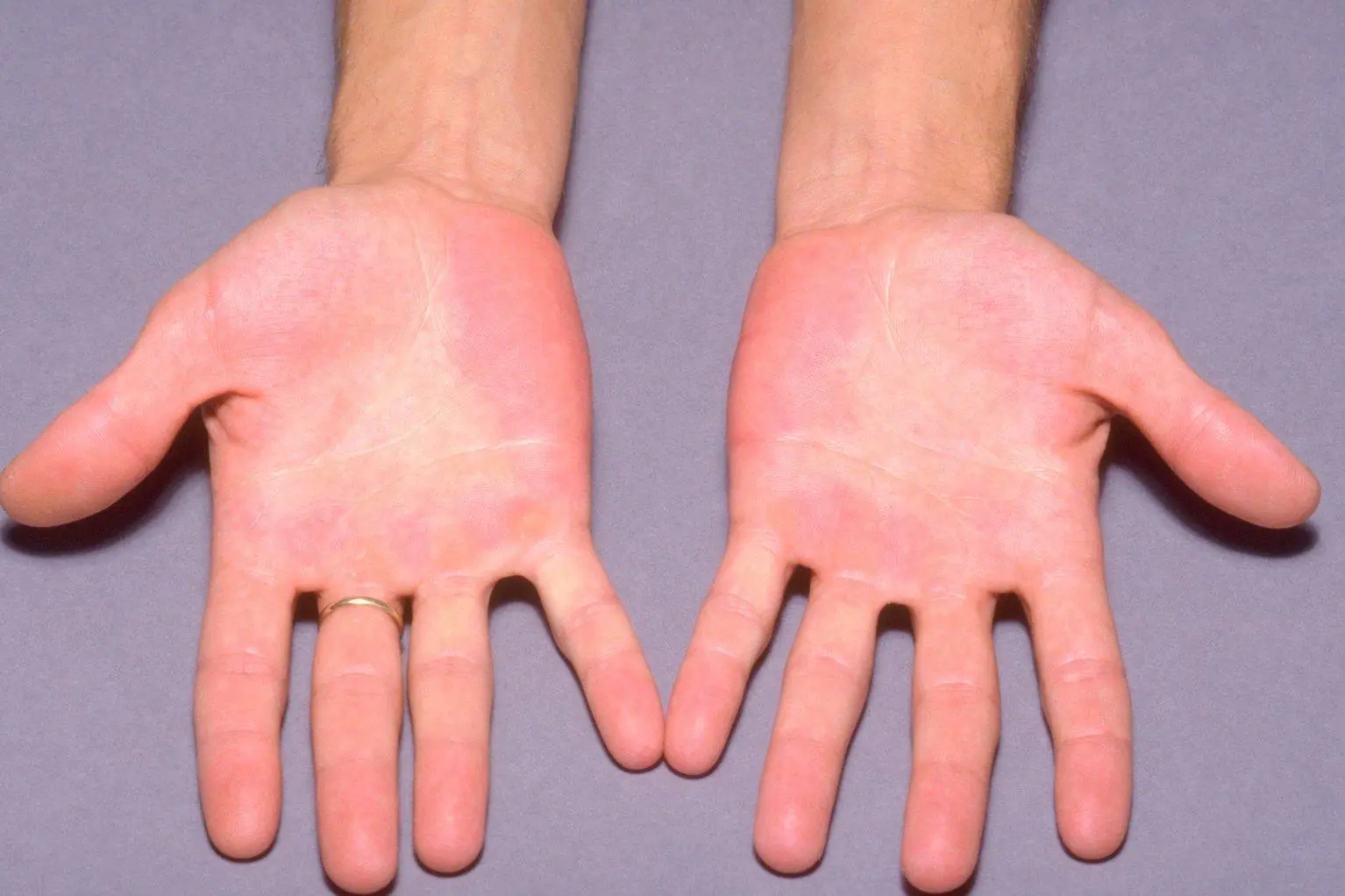 These 3 Hand Symptoms May Be Linked to Serious Liver Problems