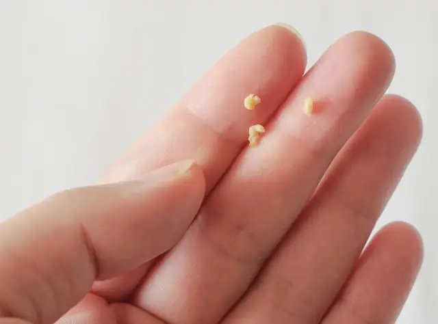 Doctors Reveal the Strange White “Pebbles” in Your Throat Many People Mistake for Something Serious