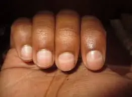 Those Small Lines on Your Nails Might Be Telling You Something Important