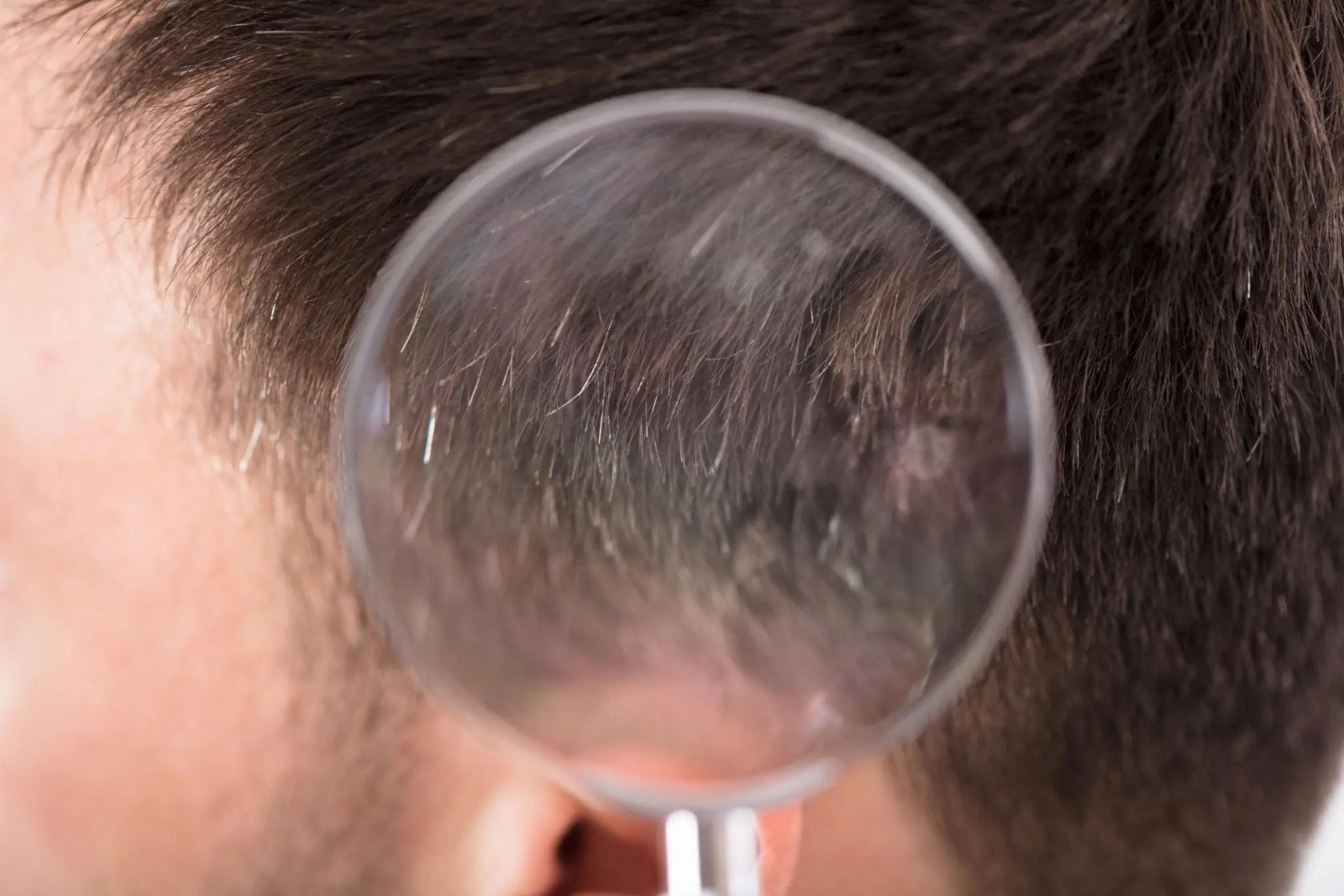 Experts Say One Early Can.cer Symptom Is Frequently Confused With Dandruff