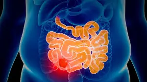 Doctors say these symptoms shouldn’t be ignored. One woman learned that lesson after being diagnosed with stage 4 colon cancer
