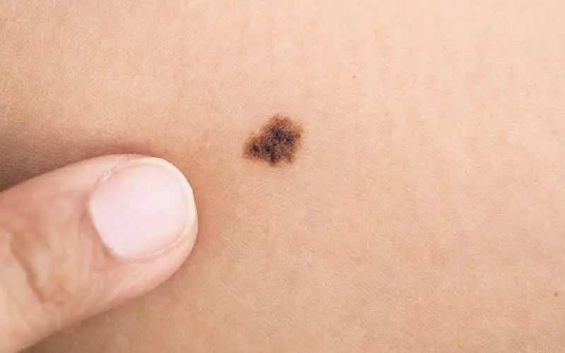 Doctors Say Certain Moles Can Be Silent Warning Signs Beneath the Skin