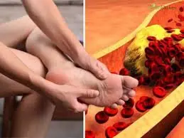 10 Early Signs of Poor Circulation and Clogged Arteries