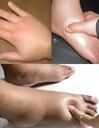Swollen Hands and Feet: Common Causes and Hidden Dangers