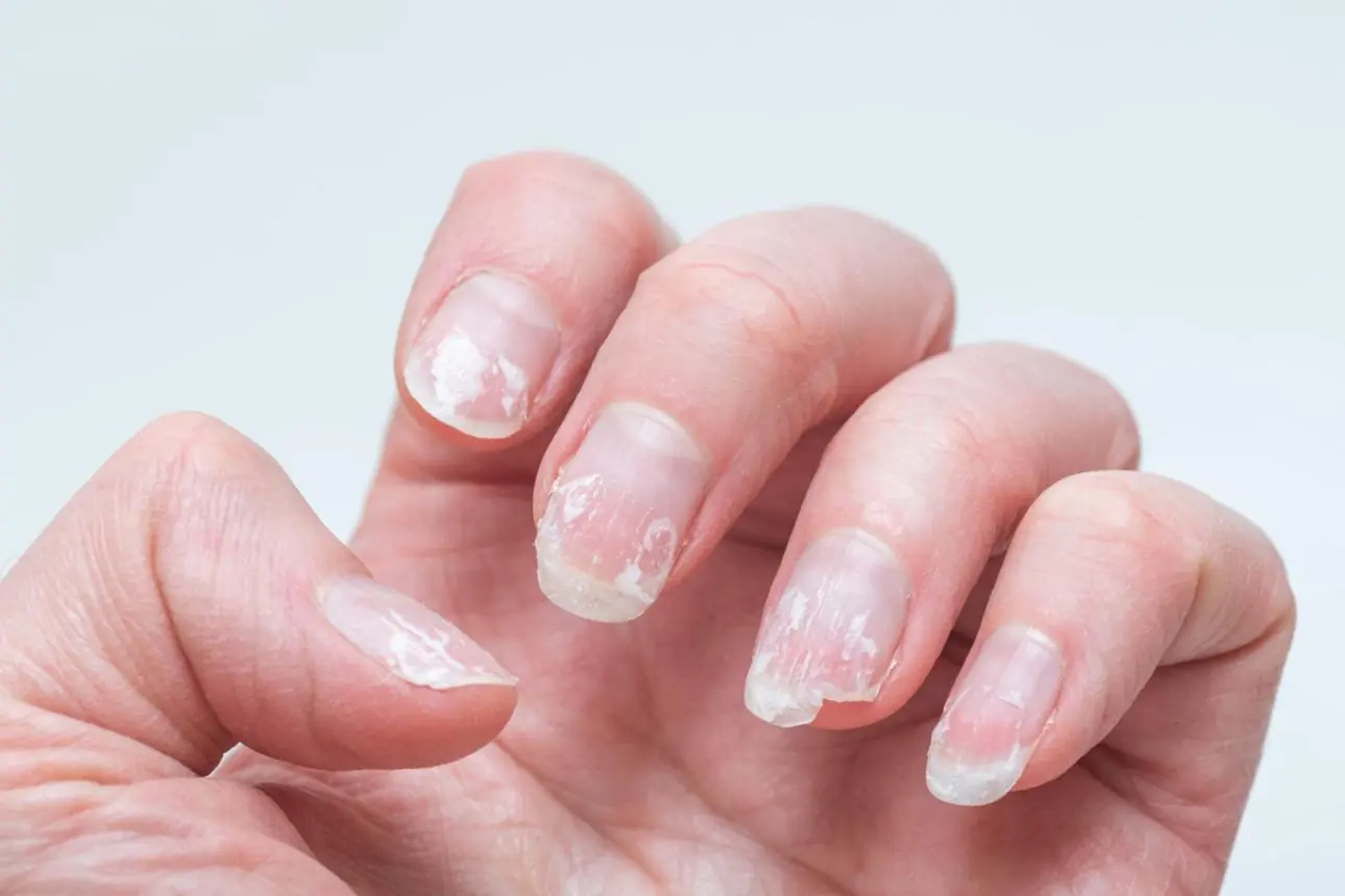Brittle or Splitting Nails? Your Body May Be Warning You About Nutrient Deficiency
